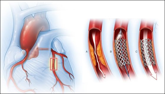Angiography