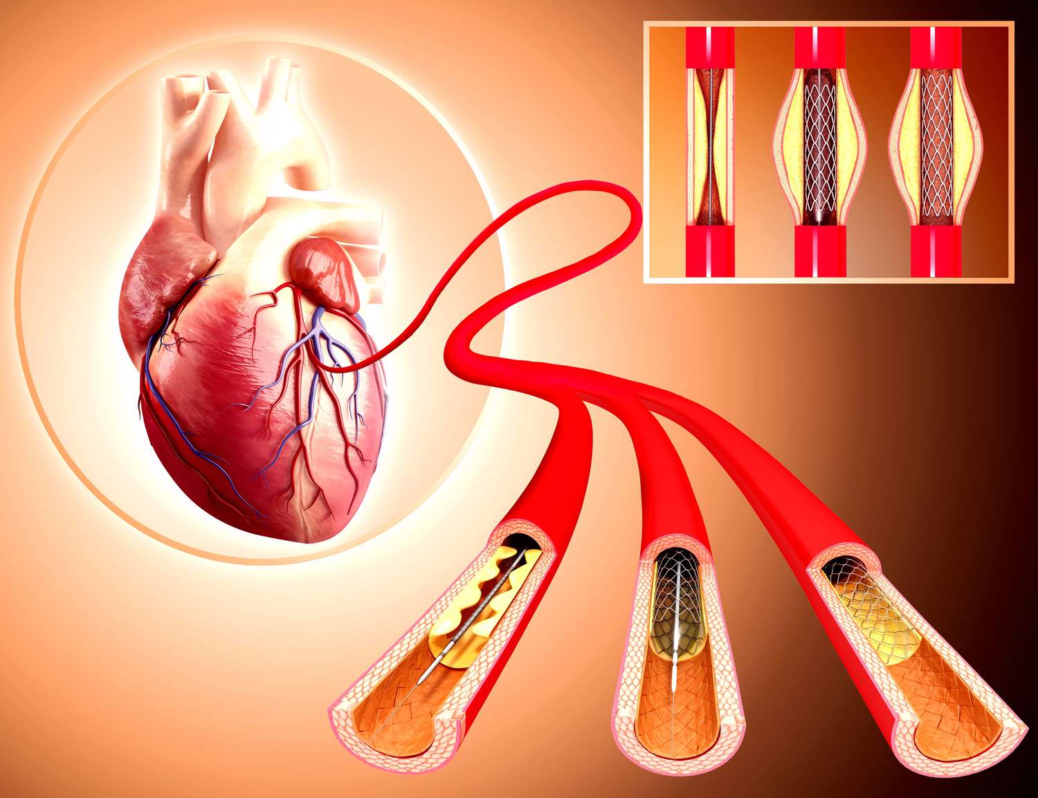 Angioplasty (Stent Placement)